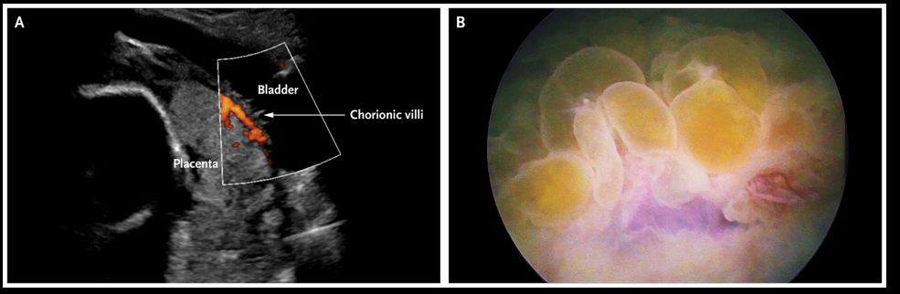 Image of Placenta Percreta invading the maternal bladder