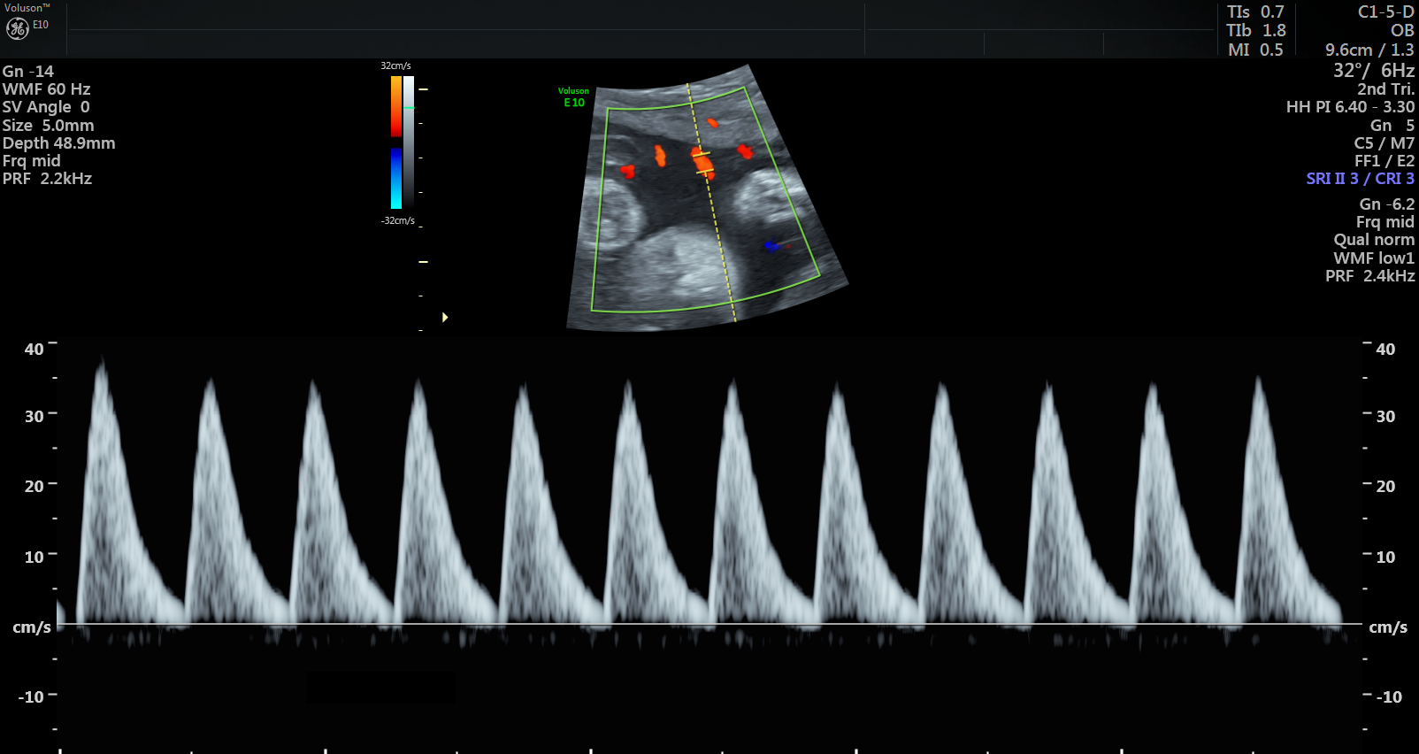 Ultrasound scan showing abnormal blood pulse pattern, indicating MVM