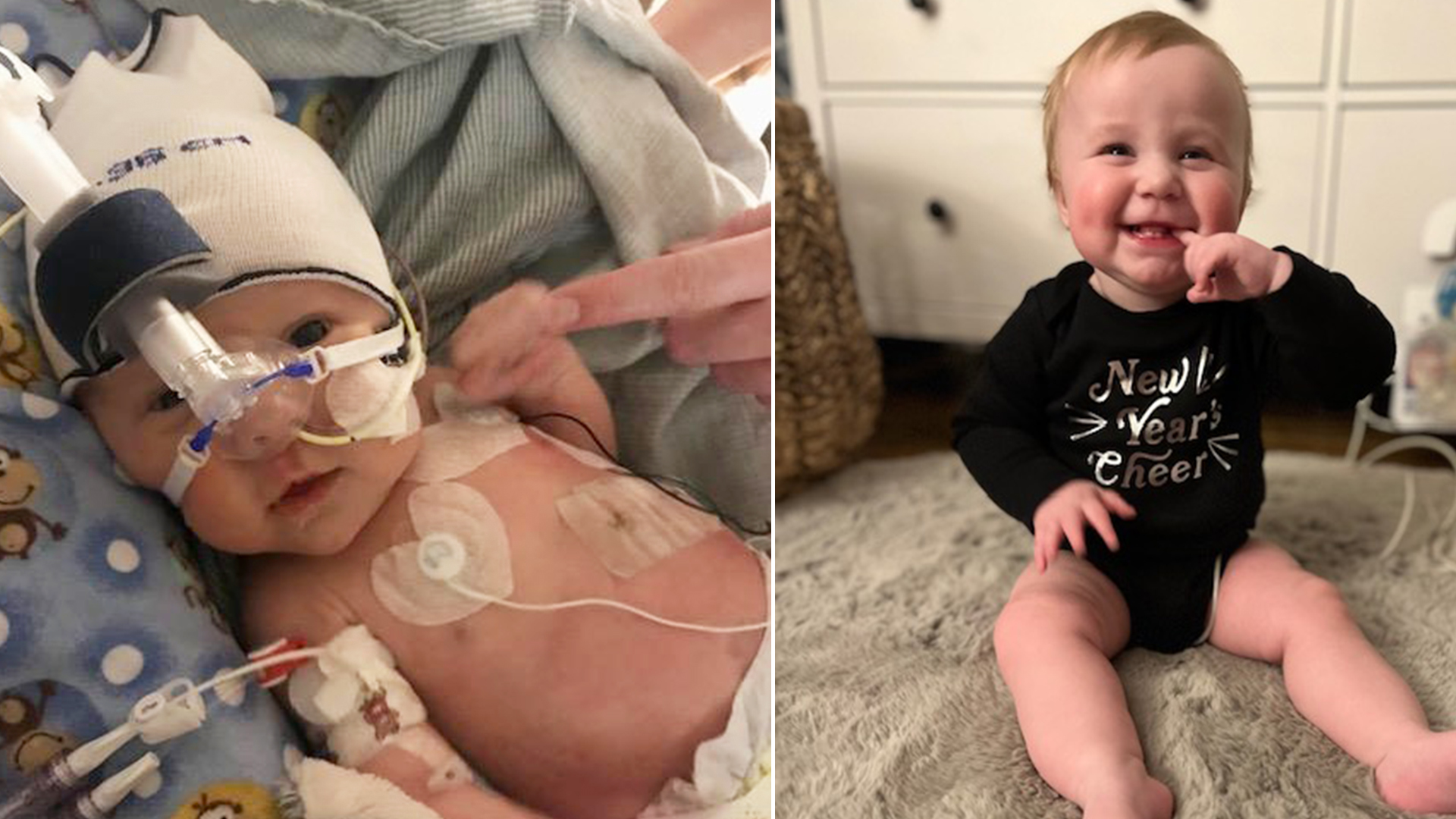 Baby who had life-saving fetal surgery celebrates first birthday