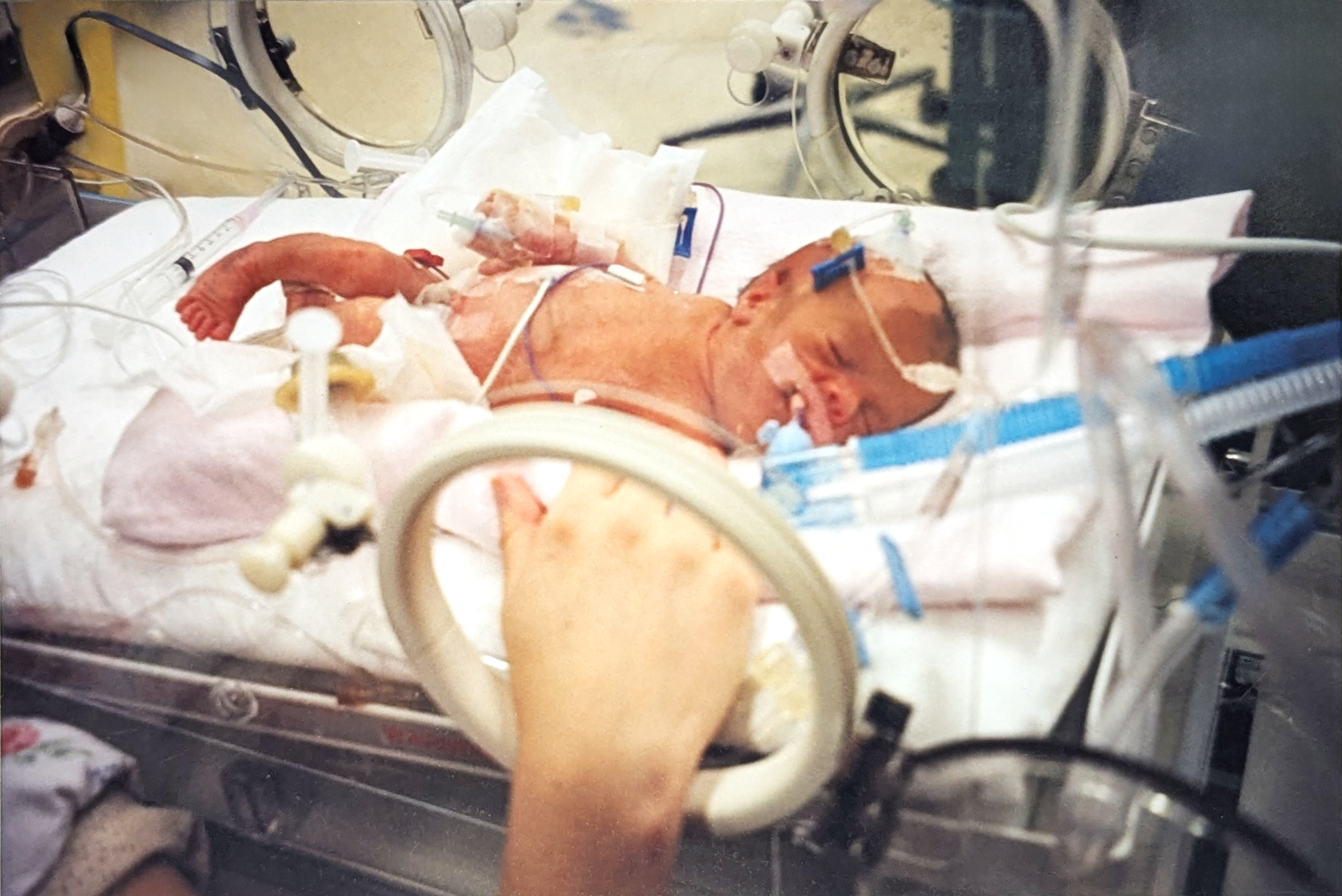 preemie baby lying in an incubator