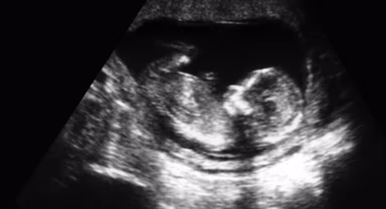 an ultrasound image of a fetus