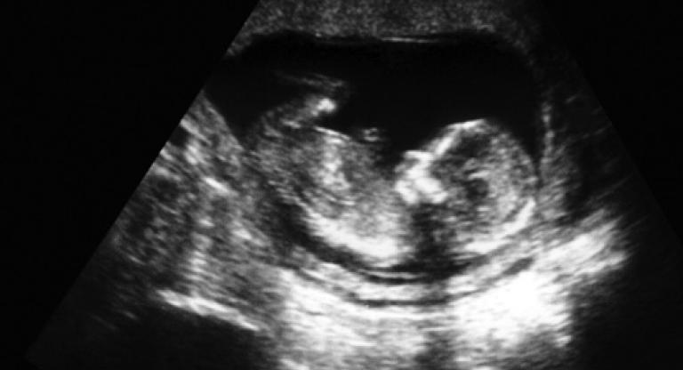 an ultrasound image of a fetus