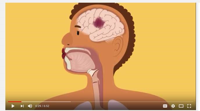 Video 3: Swallowing and Communication after Stroke