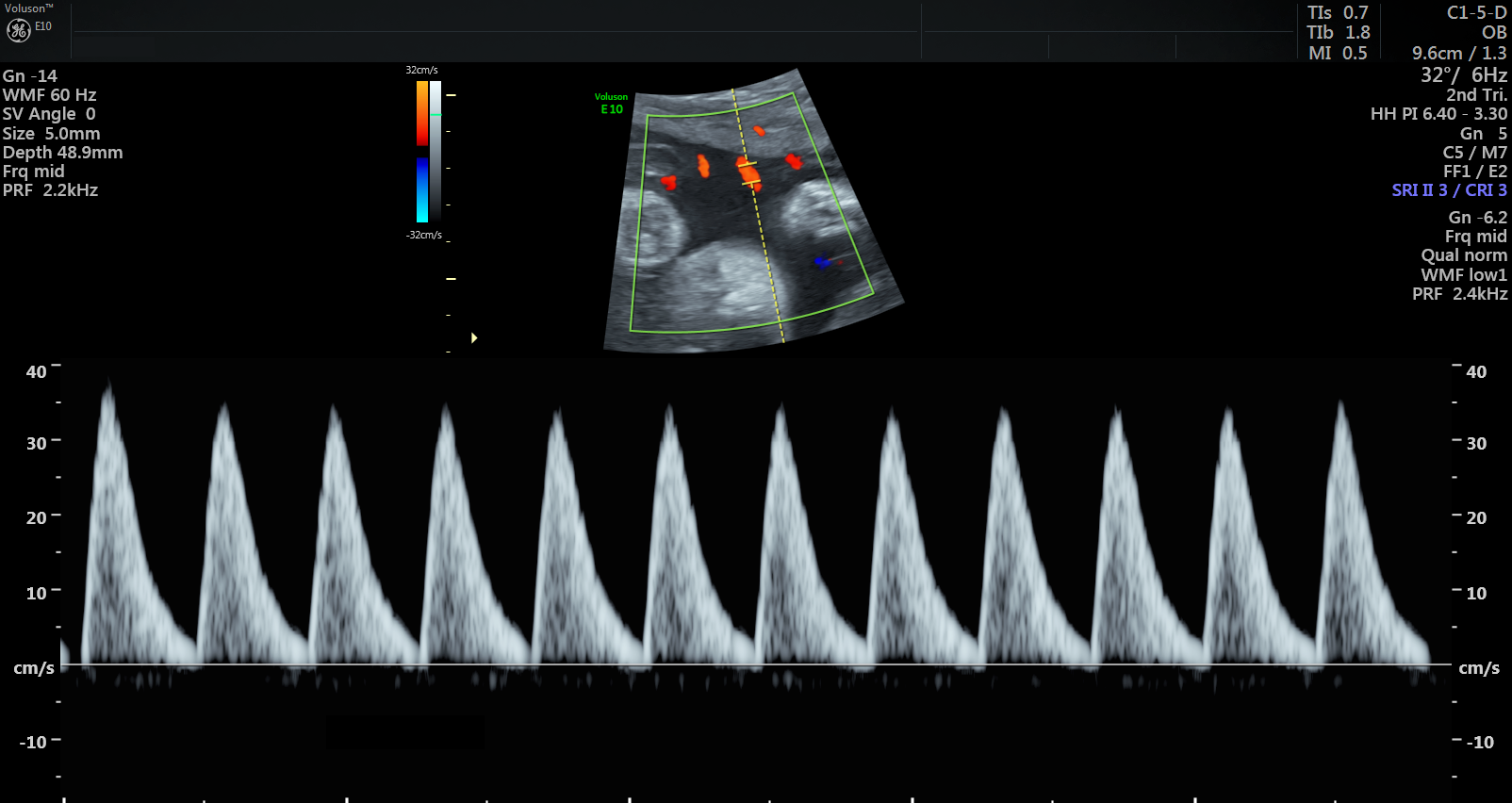 : Ultrasound scan showing abnormal blood pulse pattern, indicating MVM