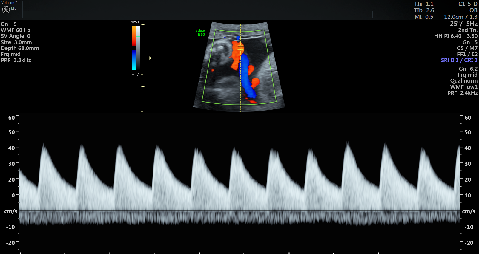 Ultrasound scan showing normal blood pulse pattern.
